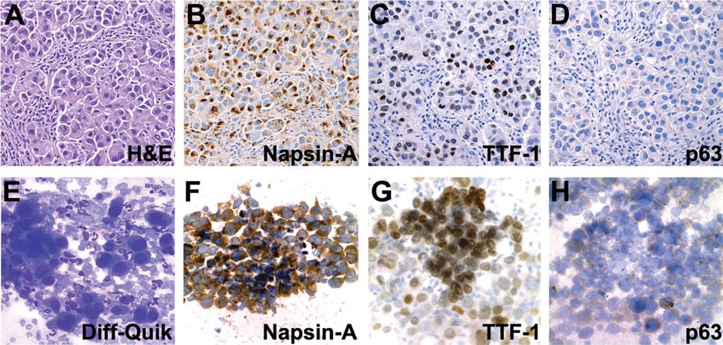 ROH ET AL. Fig. 1. Immunoperoxidase studies for Napsin-A, TTF-1, and p63 performed on histologic sections and direct smears in a case of a poorly differentiated adenocarcinoma.