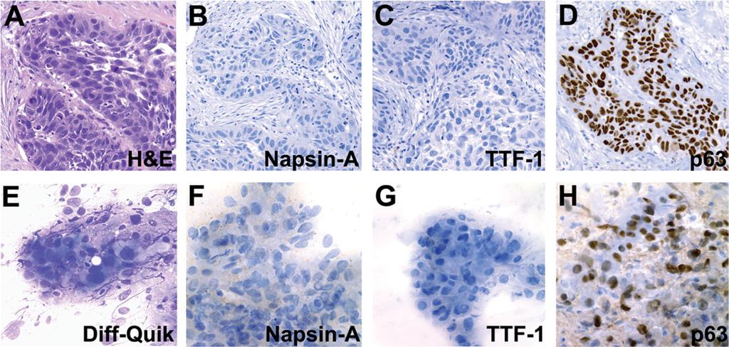 NAPSIN-A, TTF-1, AND p63 IMMUNOCYTOCHEMISTRY Fig. 3. Immunoperoxidase studies for Napsin-A, TTF-1, and p63 performed on histologic sections and direct smears in a case of a SQC.