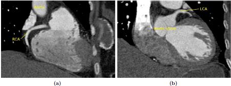 Fig. 1. A CTA image of the human heart showing coronaries (a) Coronal view showing RCA (b) coronal view showing LCA Fig. 3.
