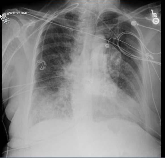 PRESENTATION The patient was diagnosed with septic shock from a right lower lobe pneumonia and started on ceftriaxone and azithromycin Over the next 6 hours the patient developed worsening hypoxemic