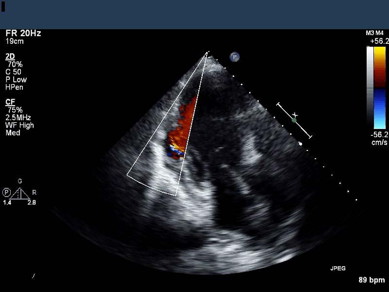 THIS PATIENT S ECHOCARDIOGRAPHY FINDING IS MOST LIKELY