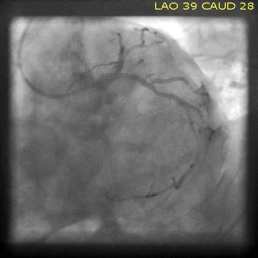 PRESENTATION Attempts at revascularization of the LAD were unsuccessful and the patient was admitted to the cardiac intensive