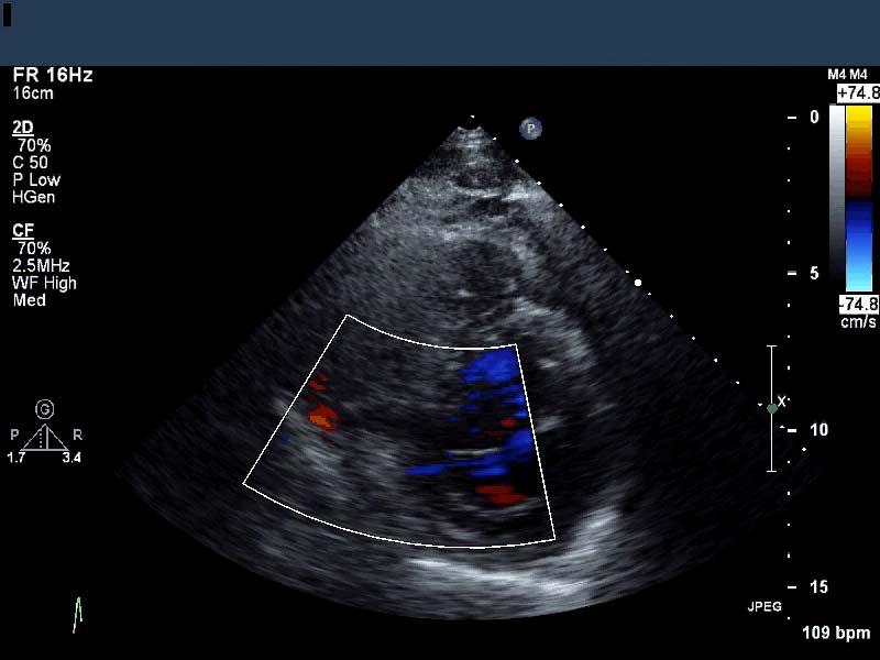 PRESENTATION The patient was sent for a right heart catheterization and coronary angiogram RHC 02 Sat: SVC: 46.3% IVC: 54.