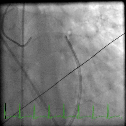 A BLOCKAGE IN WHICH CORONARY ARTERY IS MOST LIKELY