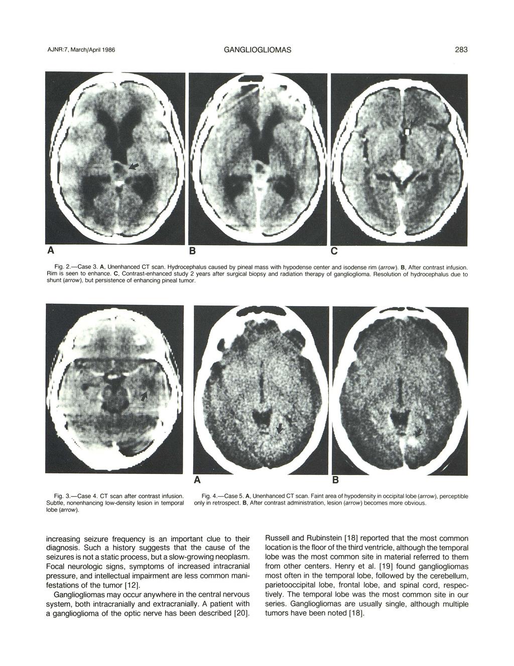 AJNR :7, March/April 1986 GANGLlOGLIOMAS 283 Fig. 2.-Case 3. A, Unenhanced CT scan. Hydrocephalus caused by pineal mass with hypodense center and isodense rim (arrow). e, After contrast infusion.