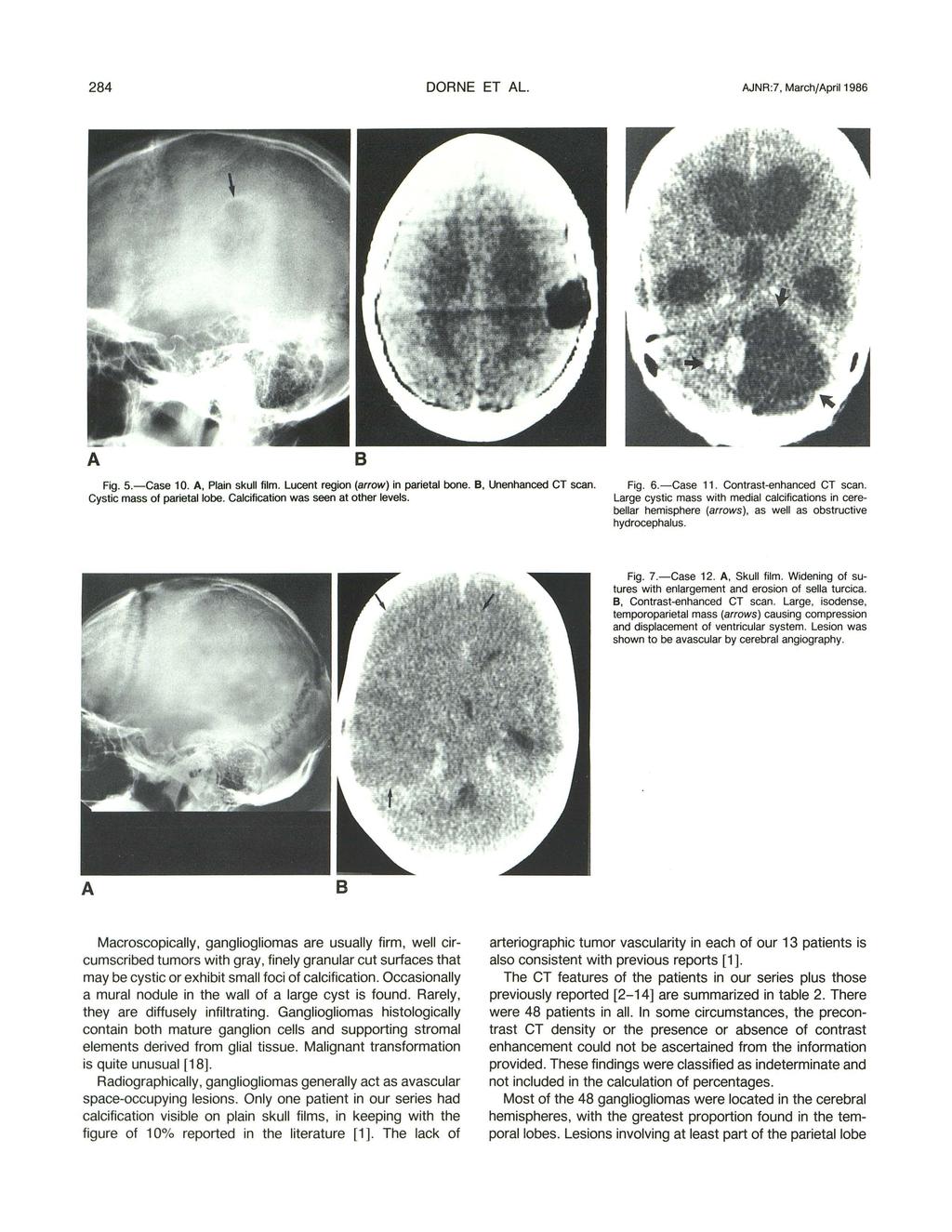284 DORNE ET AL. AJNR :7, March/April 1986 A B Fig. 5.-Case 10. A, Plain skull film. Lucent region (arrow) in parietal bone. B, Unenhanced CT scan. Cystic mass of parietal lobe.