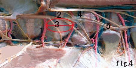 Left view: 1 aorta; 2 starting point of segmental arteries; 3 distance between segmental arteries; 4 segmental artery; 5 intervertebral place; 6 T 12 rib. Figure 3.