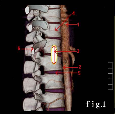 Left view: 1 segmental artery; 2 T 12 intervertebral disc; 3 distance between both segmental arteries; 4 segmental vein; 5 sympathetic nerve. are bilaterally symmetrical (27/29).