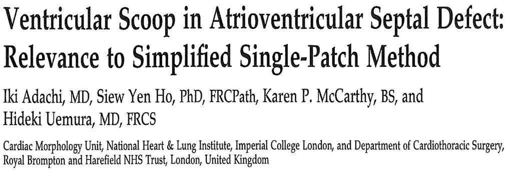 Morphology of LVOT in AVSD: Ventricular Septal Scoop Ann Thor Surg 2009;87:198-203 50% of CAVSD specimens had anterosuperior
