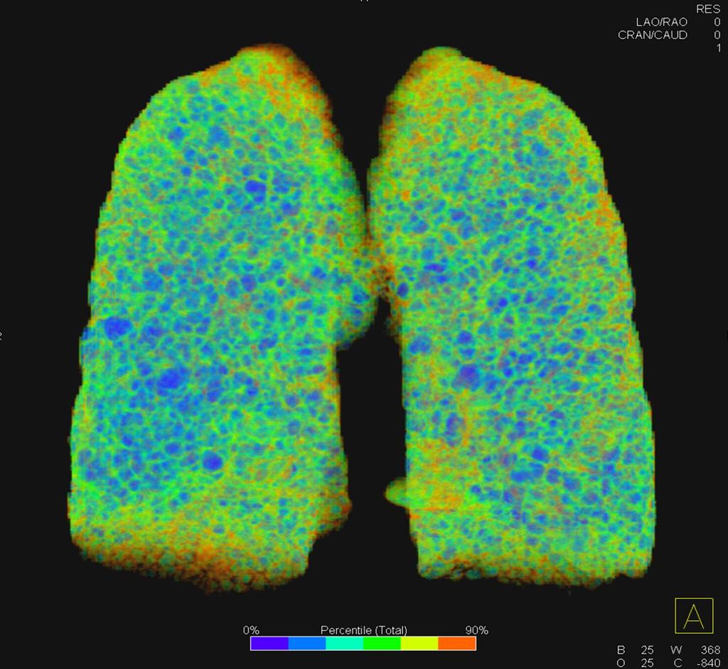 Lung density