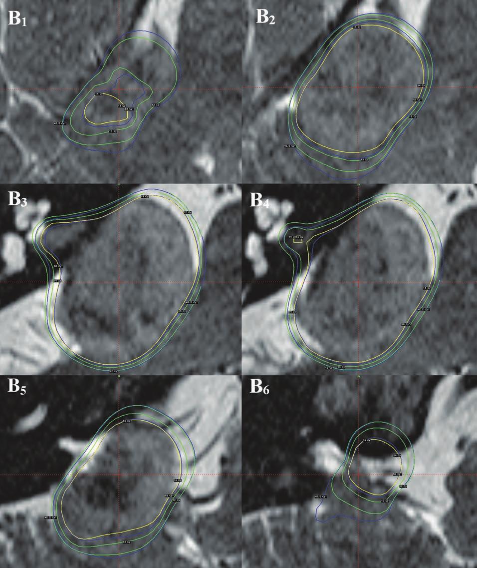 Application of biological effective dose to radiosurgery Figure 5.