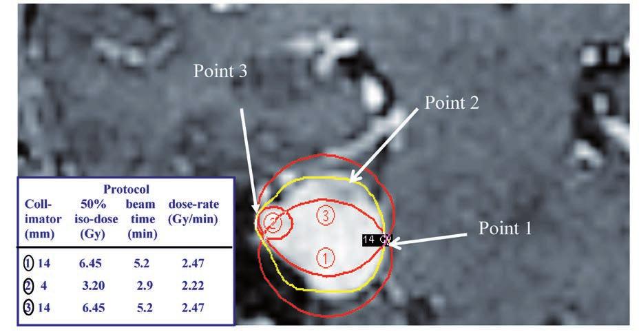 John W. Hopewell et al. Figure 1. MR image showing the location of the 50% iso-dose lines for the three iso-centers used in the of the contrast enhanced tumor (red lines).