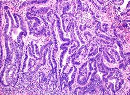 Serous carcinoma p53 p16