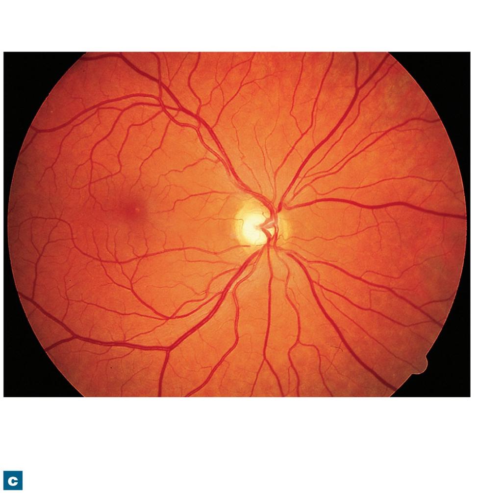 Figure 17-7c The Organization of the Retina Fovea Optic disc (blind spot) Macula Central retinal