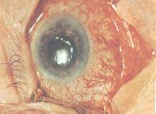 Nausea 3. Vomiting 4. Blur vision 5. Seeing haloes Signs 1. Hazy cornea (Figure 4) 2. Mid-dilated and unreactive pupil (Figure 4) 3. Ciliary injection (Figure 4) 4.