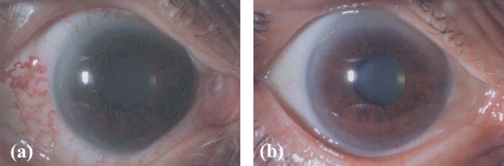 606 Jpn J Ophthalmol Vol 47: 603 608, 2003 Conjunctival hyperemia and vasodilation in the sclera and retina were observed in the right eye. The angle was wide open (Shaffer s classification grade 4).