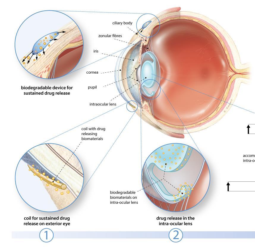 InSciTe Ophthalmology: the OCDC-project The biomedical Ocular Coil Drug delivery Comfort (OCDC) project Purpose: to incorporate an NSAID