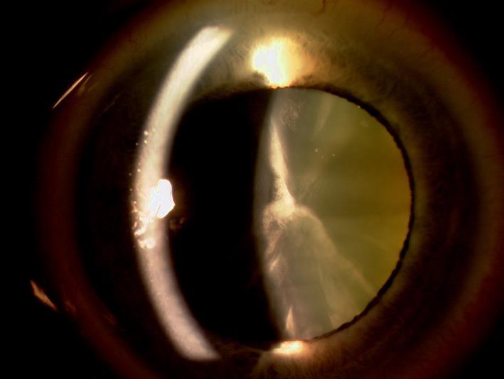 Unmet Need Ophthalmology: Optimize Ocular Drug Delivery Ocular drug