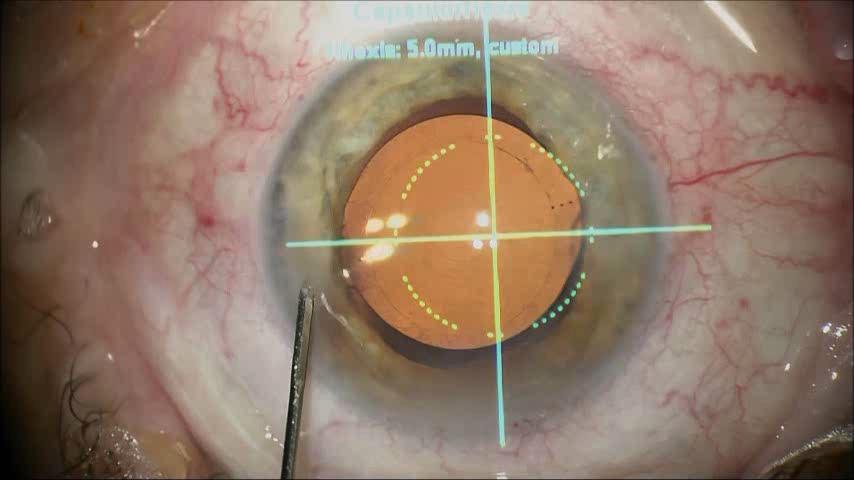 lens and implantation of