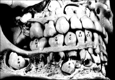 TEETH; Deciduous (baby, milk) 10 First complete set; erupt approx. 6 months. Lower central incisors- first to erupt.