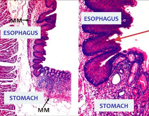 ESOPHAGEAL/GASTRIC JUNCTION Cardiac Region of Stomach 17 NOTE: Abrupt change from protective Stratified Squamous Epith.