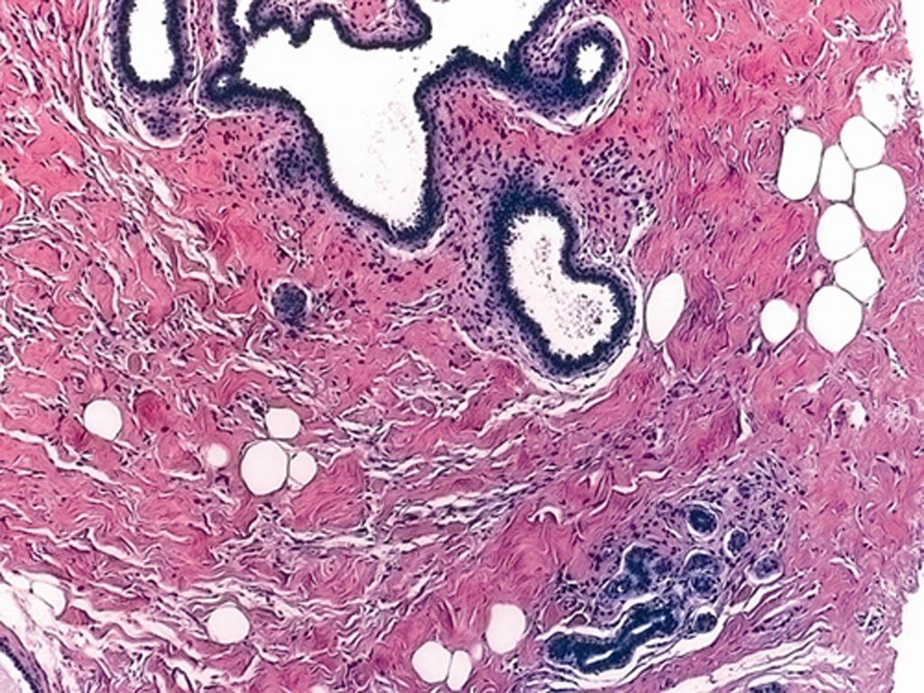 In our practice we have frequently encountered an intimate association of columnar cell lesions with PASH-like stroma in core needle biopsies, a lesion we designated as CCPLS.