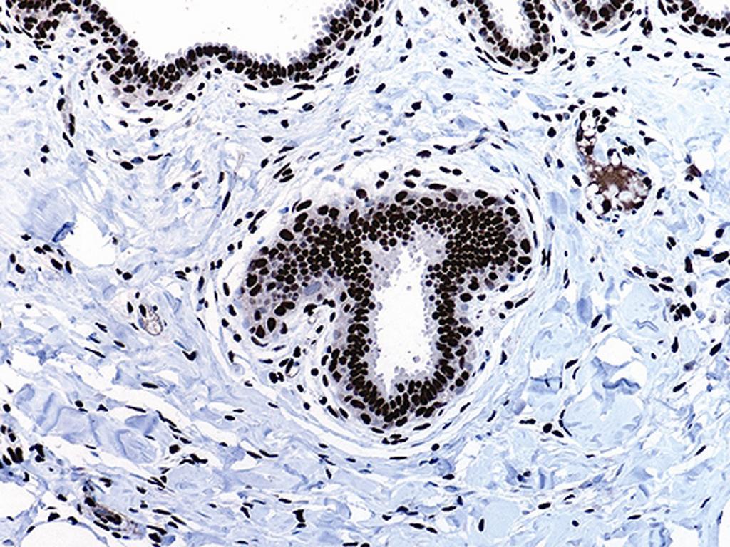 Columnar cell lesions and pseudoangiomatous hyperplasia like stroma Figure 3.