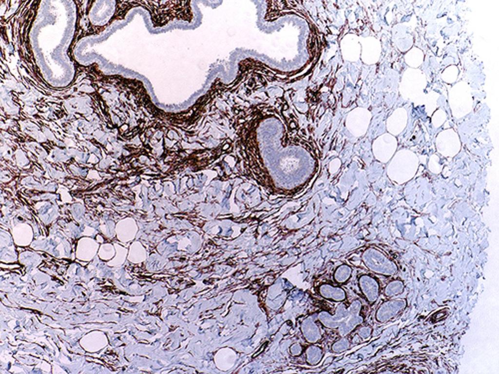 Columnar cell lesions and pseudoangiomatous hyperplasia like stroma Figure 5. CD34 highlights PASH-like stroma (103). Figure 6.