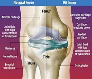 1. Symptoms of knee osteoarthritis: Pain; Stiffness; Crepitations (creaking sounds); Joint deformity; Swelling; Muscle weakness. 2.
