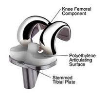 Barrow will have selected for your knee the most appropriate procedure. When performing a knee replacement, Dr.