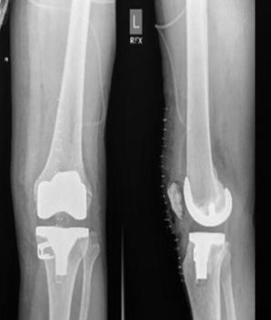 The senior author (JM) once again evaluated the balance of the knee with the trial implants in to ensure optimal balance.
