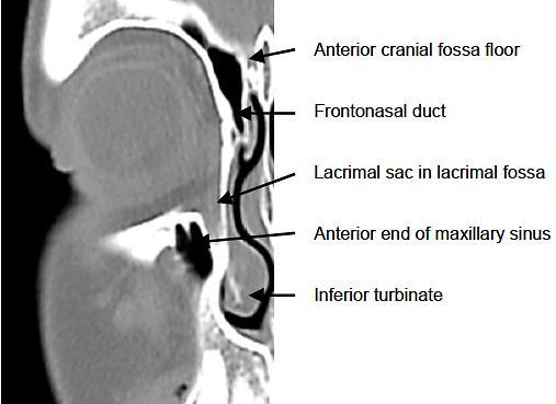 created by the maxillary and lacrimal bones and opens into the inferior meatus of the nose (Figures 1-3).