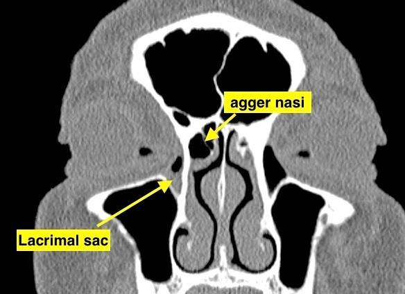 It is important to note that the lacrimal bone and sac are located just anterior to the orbit.