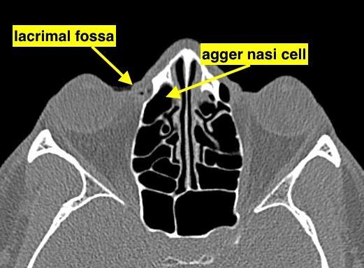 The lacrimal sac extends approximately 9mm above the axilla of the middle turbinate (Figure 4).