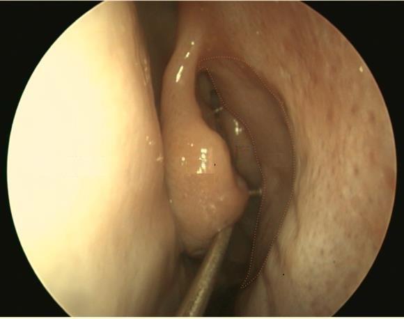 Endoscopic DCR surgery technique Anaesthesia and preparation of surgical field Surgery is performed under general anaesthesia with the endotracheal tube out of the way of the endoscope and