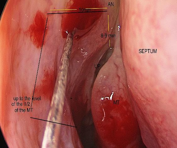2. Create a posteriorly based mucosal flap to expose the lacrimal bone Use a no 15 scalpel blade to make a superior incision that runs horizontally 8-9 mm above the axilla of the middle turbinate