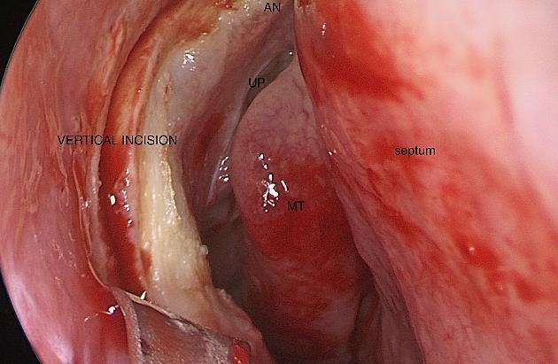inferior incision from the insertion of the uncinate to join the vertical incision (Figures 12, 14) 3.