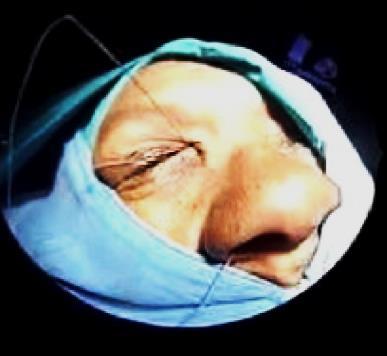 lacrimal sac Return the remainder of the flap onto the lateral wall and ensure that the exposed bone is covered 8.