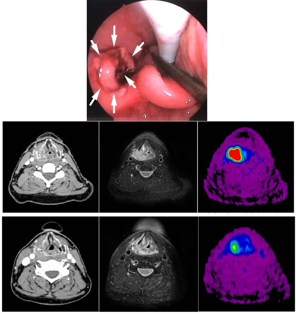 Target volumes in Radiation Oncology Right piriform sinus (ICDO-10: C12.