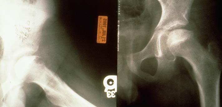 PERTHES DISEASE Diagnosis made from x ray: subchondral