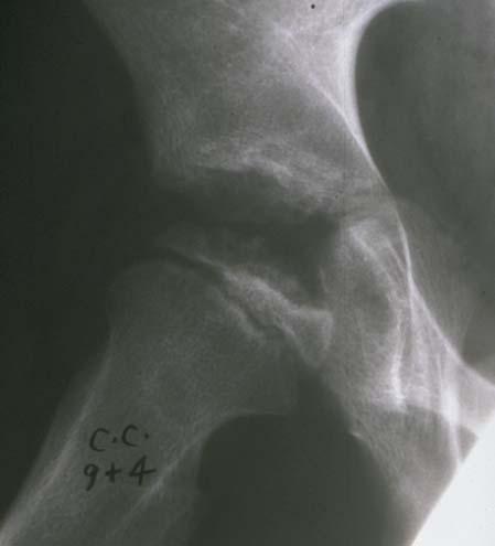 PERTHES DISEASE Disease runs course of several years Dead bone reabsorbed then