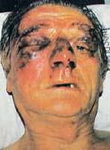 Injuries Facial soft tissue injuries often appear serious Seldom life threatening Exceptions Compromised upper
