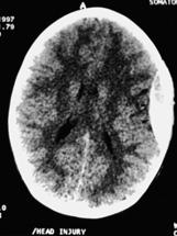Epidural Hematoma Collection of blood between cranium and dura in epidural space Rapidly developing lesion from