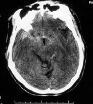Subarachnoid Bleeding Intracranial bleeding into CSF, resulting in bloody CSF and meningeal irritation Signs and symptoms Intracerebral Hematoma > 5 ml blood somewhere within brain Commonly frontal