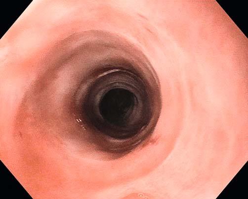 Fig.1 Endoscopy from a patient with lymphocytic esophagitis showing a narrowed esophagus with rings. Fig.2 Histology from the patient in Fig.