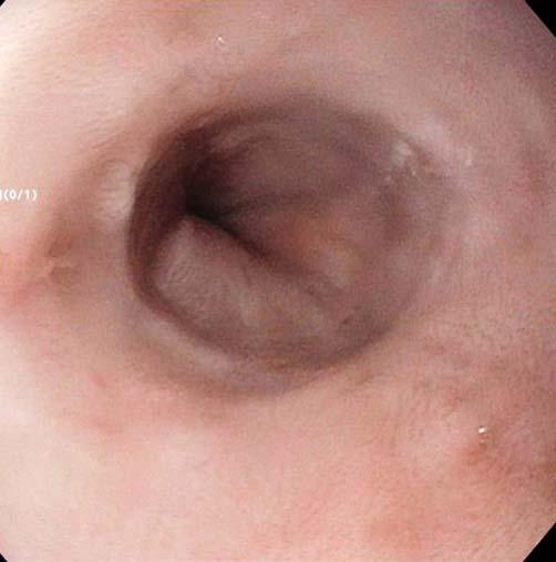 Fig.3 A patient with lymphocytic esophagitis with concentric rings on endoscopy. Fig.4 A patient with lymphocytic esophagitis with a distal esophagus ring on endoscopy.