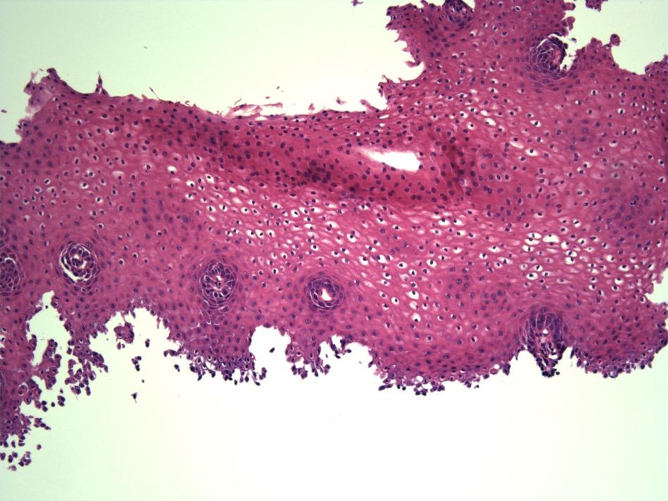 Pemphigus vulgaris; esophageal