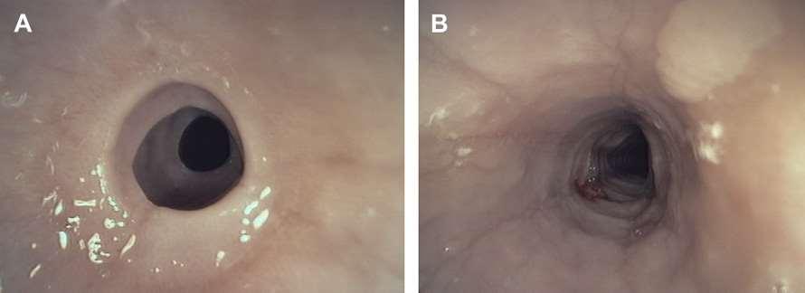 Proximal strictures related to eosinophilic esophagitis