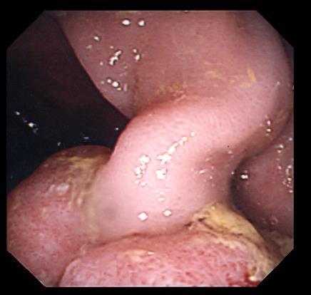 Polyp Removal The majority of polyps can be removed endoscopically depending