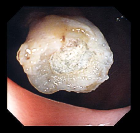 Larger stalked polyps are usually snare resected, whilst sessile polyps